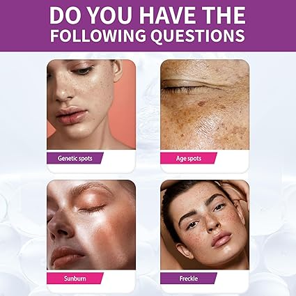 Spot Fading Urea Cream,Dark Spot Reducing Creams,๐๐ก๐ข๐ญ๐๐ง๐ข๐ง๐  and ๐
๐ซ๐๐๐ค๐ฅ๐ Removal Reduce Dark Spots Cream