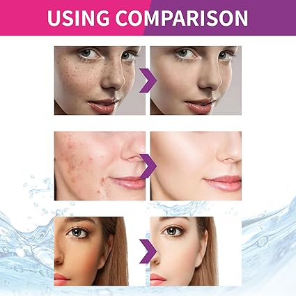 Spot Fading Urea Cream,Dark Spot Reducing Creams,๐๐ก๐ข๐ญ๐๐ง๐ข๐ง๐  and ๐
๐ซ๐๐๐ค๐ฅ๐ Removal Reduce Dark Spots Cream