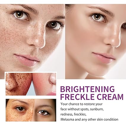 Spot Fading Urea Cream,Dark Spot Reducing Creams,𝐖𝐡𝐢𝐭𝐞𝐧𝐢𝐧𝐠 and 𝐅𝐫𝐞𝐜𝐤𝐥𝐞 Removal Reduce Dark Spots Cream